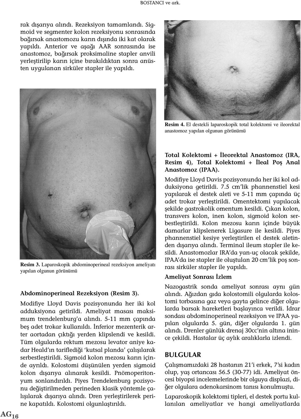 El destekli laparoskopik total kolektomi ve ileorektal anastomoz yap lan olgunun görünümü Total Kolektomi + İleorektal Anastomoz (IRA, Resim 4), Total Kolektomi + İleal Poş Anal Anastomoz (IPAA).