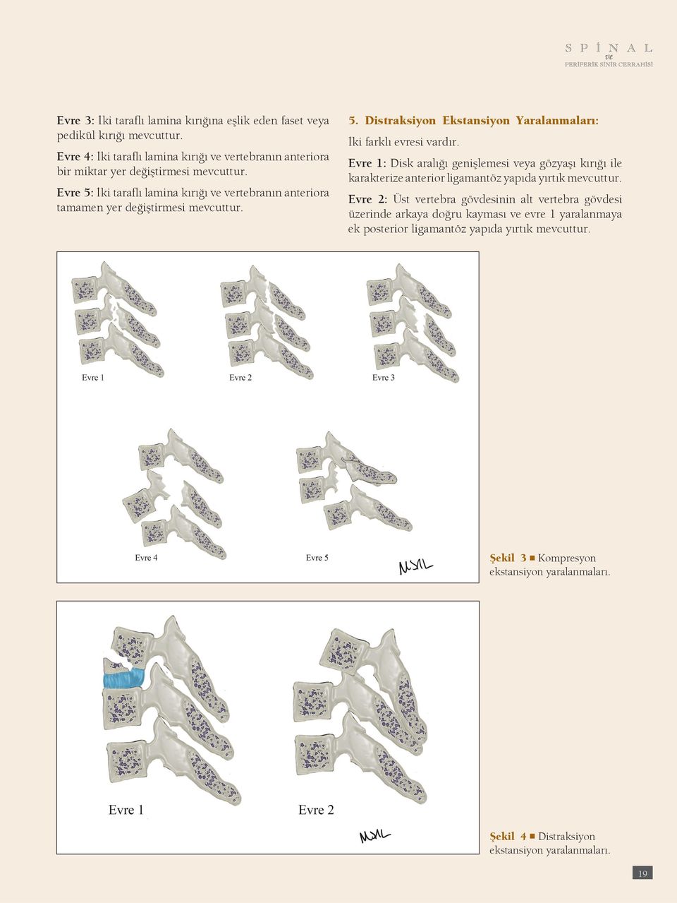 Evre 5: İki taraflı lamina kırığı ve vertebranın anteriora tamamen yer değiştirmesi mevcuttur. 5. Distraksiyon Ekstansiyon Yaralanmaları: İki farklı evresi vardır.