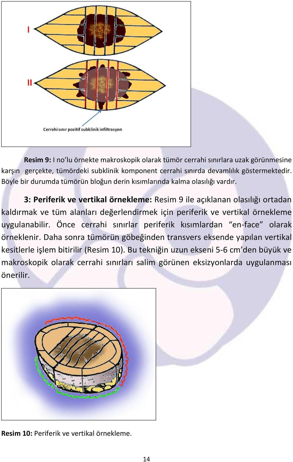 3: Periferik ve vertikal örnekleme: Resim 9 ile açıklanan olasılığı ortadan kaldırmak ve tüm alanları değerlendirmek için periferik ve vertikal örnekleme uygulanabilir.