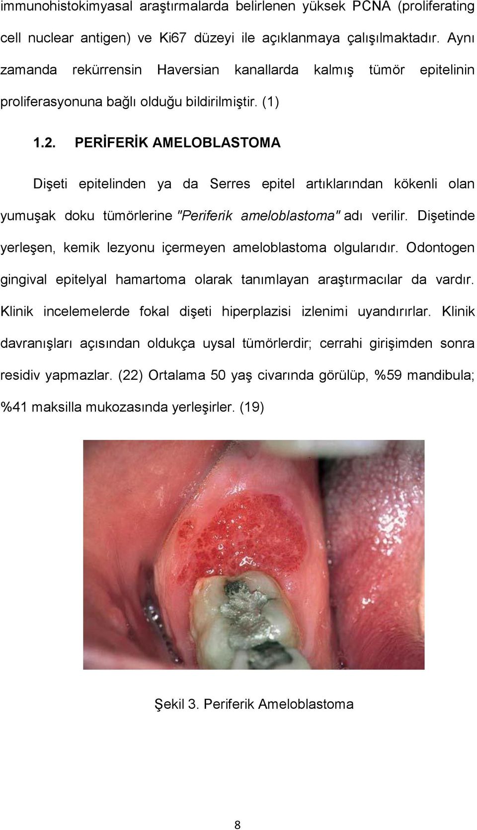 PERİFERİK AMELOBLASTOMA Dişeti epitelinden ya da Serres epitel artıklarından kökenli olan yumuşak doku tümörlerine "Periferik ameloblastoma" adı verilir.