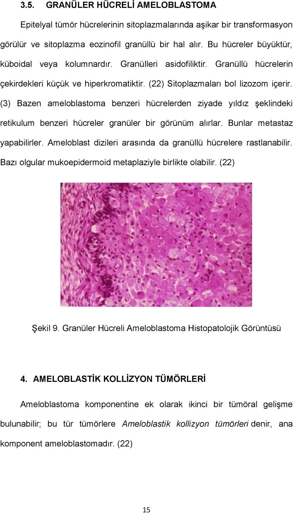 (3) Bazen ameloblastoma benzeri hücrelerden ziyade yıldız şeklindeki retikulum benzeri hücreler granüler bir görünüm alırlar. Bunlar metastaz yapabilirler.