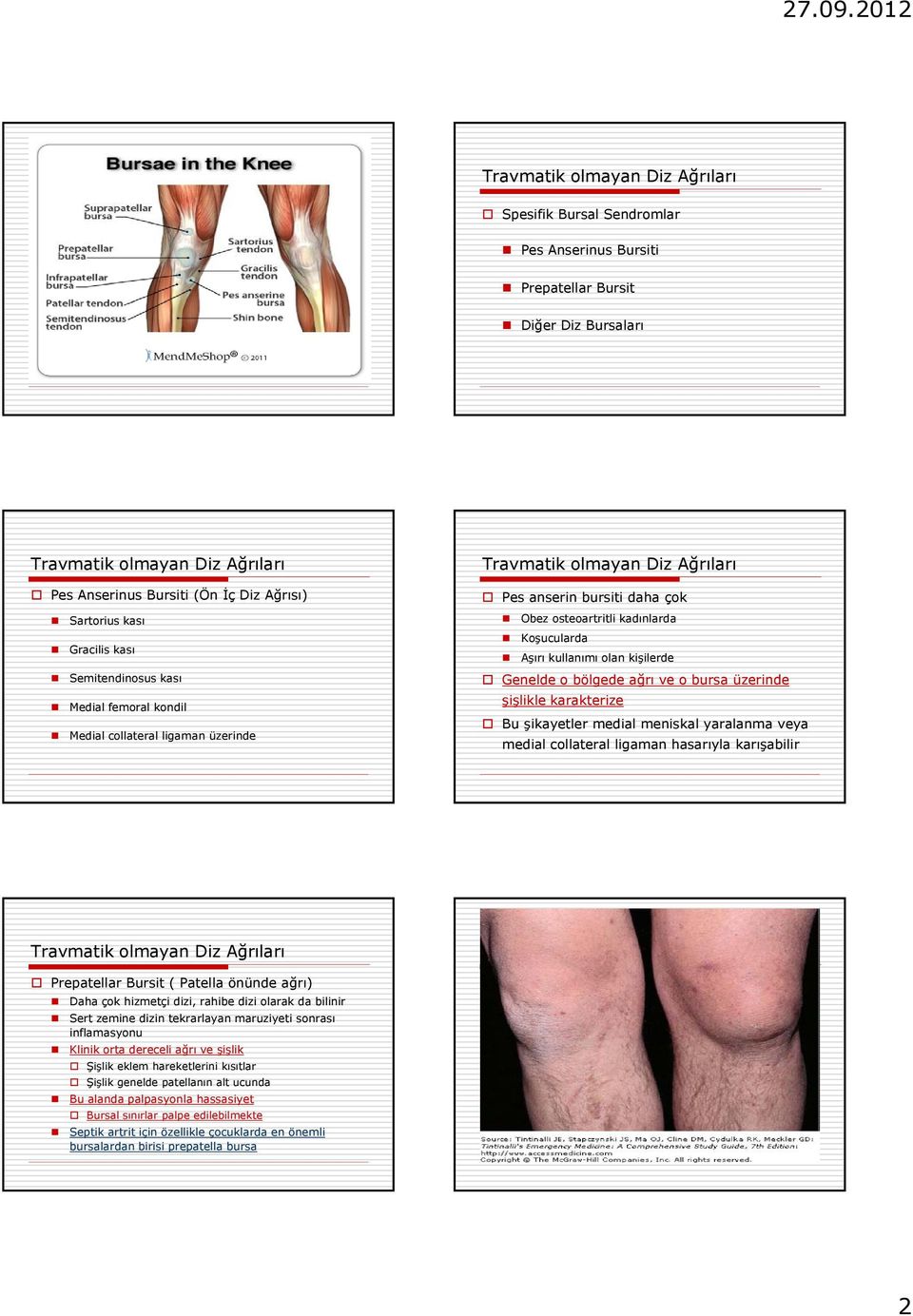 karakterize Bu şikayetler medial meniskal yaralanma veya medial collateral ligaman hasarıyla karışabilir Prepatellar Bursit ( Patella önünde ağrı) Daha çok hizmetçi dizi, rahibe dizi olarak da