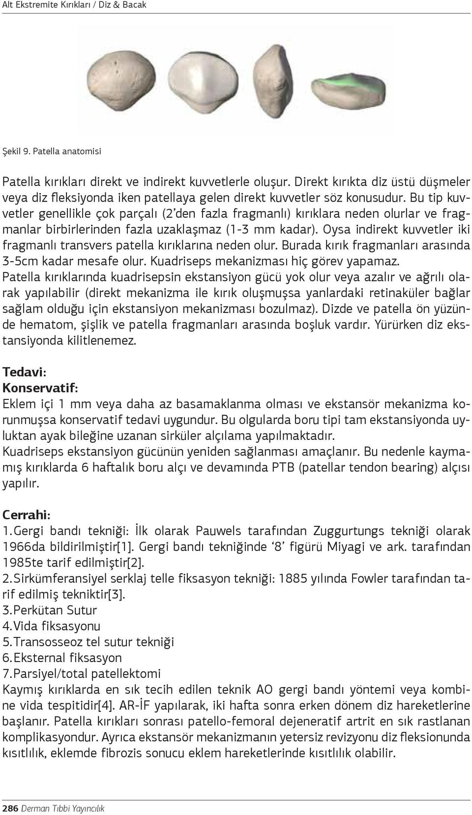 Oysa indirekt kuvvetler iki fragmanlı transvers patella kırıklarına neden olur. Burada kırık fragmanları arasında 3-5cm kadar mesafe olur. Kuadriseps mekanizması hiç görev yapamaz.