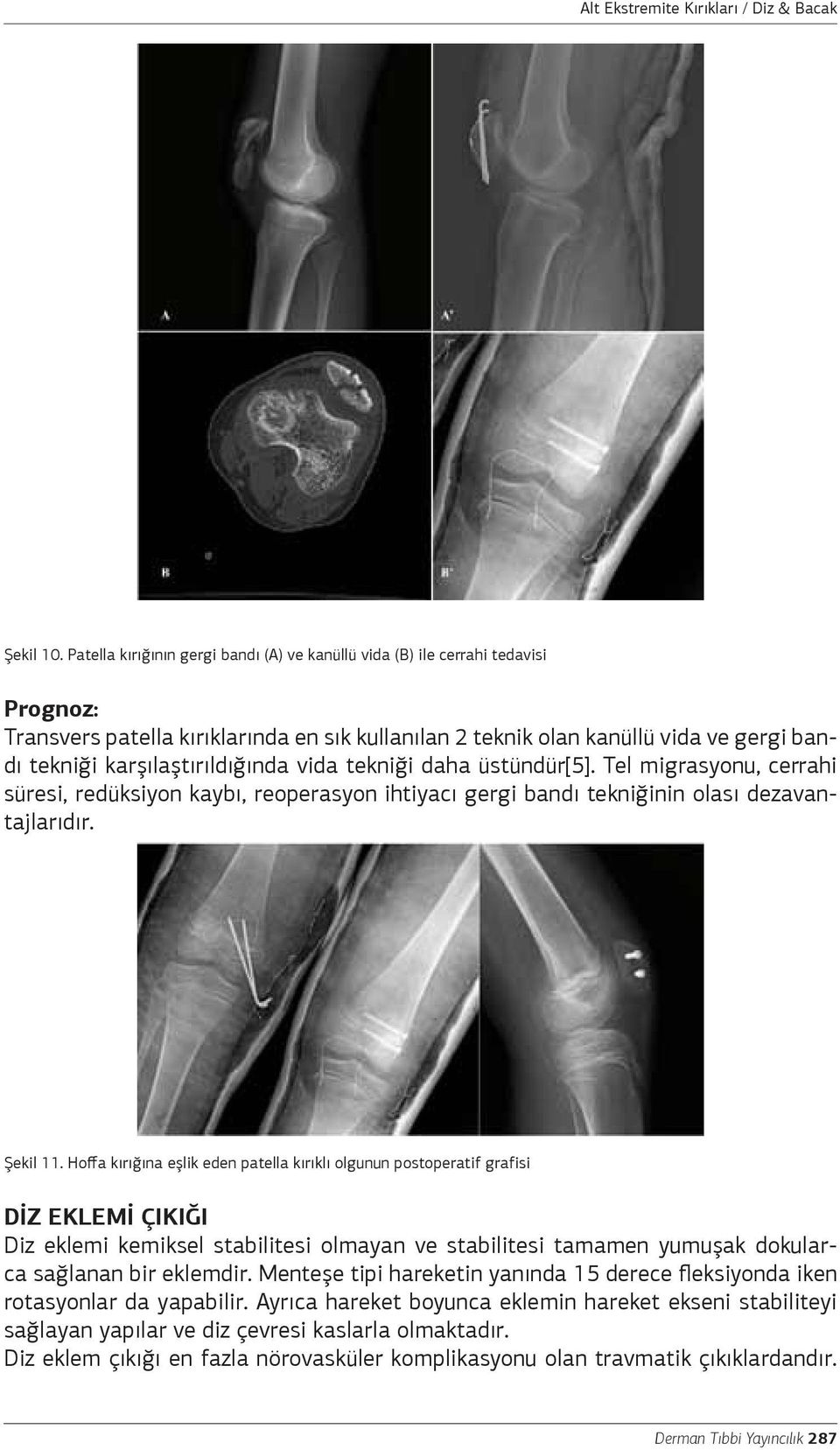 karşılaştırıldığında vida tekniği daha üstündür[5]. Tel migrasyonu, cerrahi süresi, redüksiyon kaybı, reoperasyon ihtiyacı gergi bandı tekniğinin olası dezavantajlarıdır. Şekil 11.