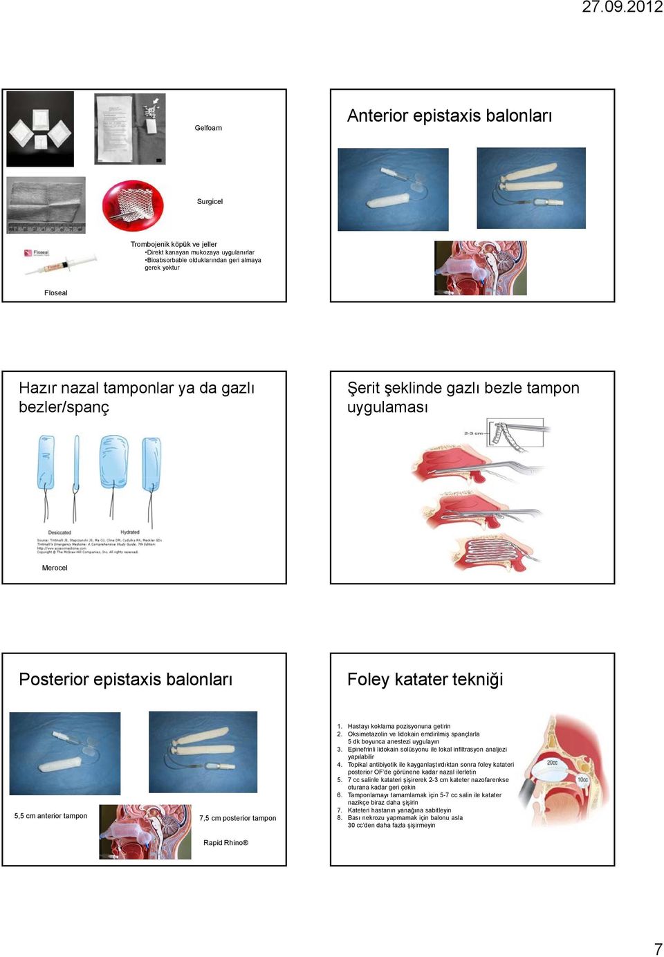 Hastayı koklama pozisyonuna getirin 2. Oksimetazolin ve lidokain emdirilmiş spançlarla 5 dk boyunca anestezi uygulayın 3. Epinefrinli lidokain solüsyonu ile lokal infiltrasyon analjezi yapılabilir 4.