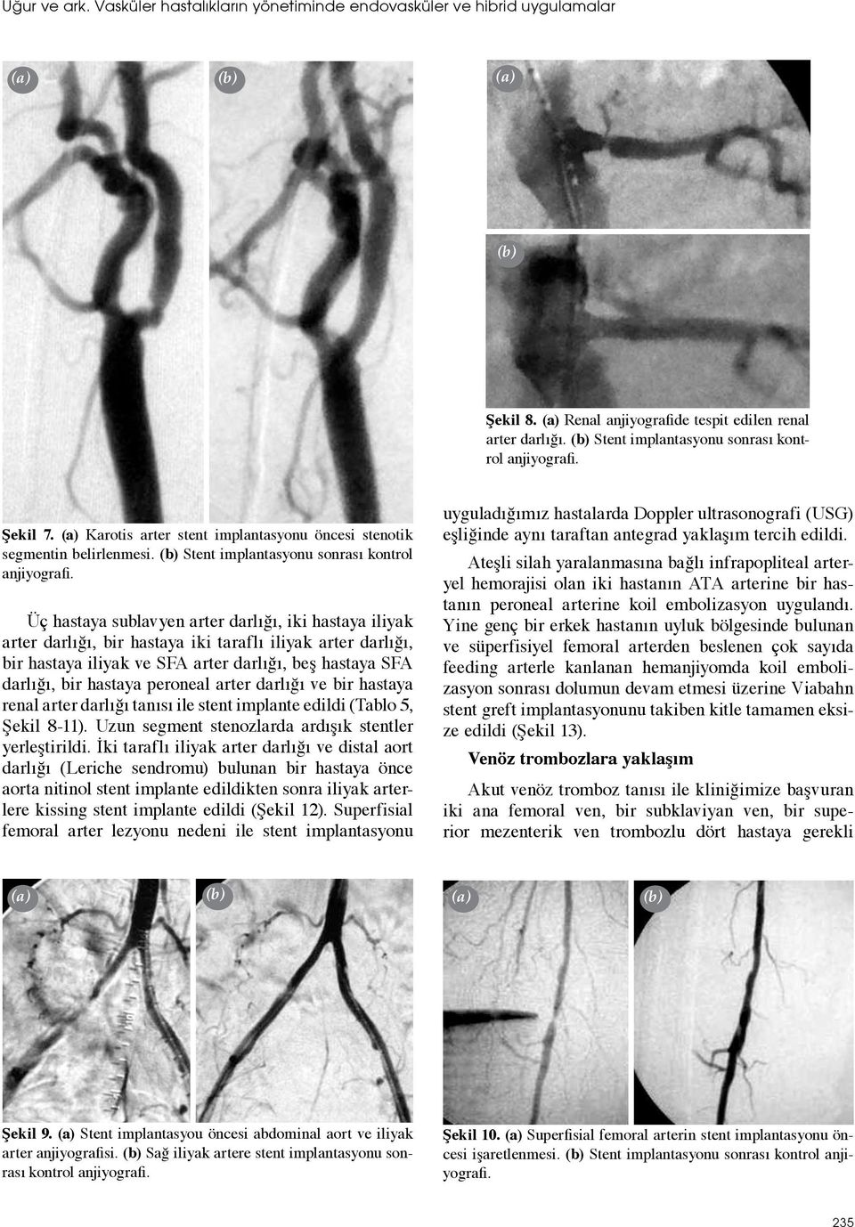 Üç hastaya sublavyen arter darlığı, iki hastaya iliyak arter darlığı, bir hastaya iki taraflı iliyak arter darlığı, bir hastaya iliyak ve SFA arter darlığı, beş hastaya SFA darlığı, bir hastaya
