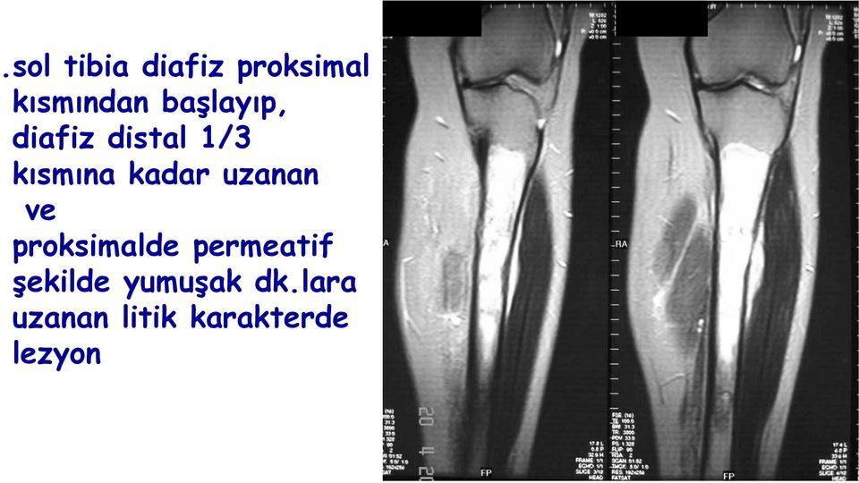 uzanan ve proksimalde permeatif şekilde