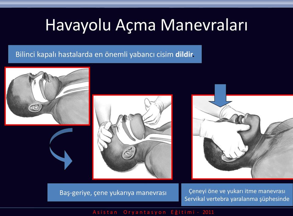 Baş-geriye, çene yukarıya manevrası Çeneyi öne