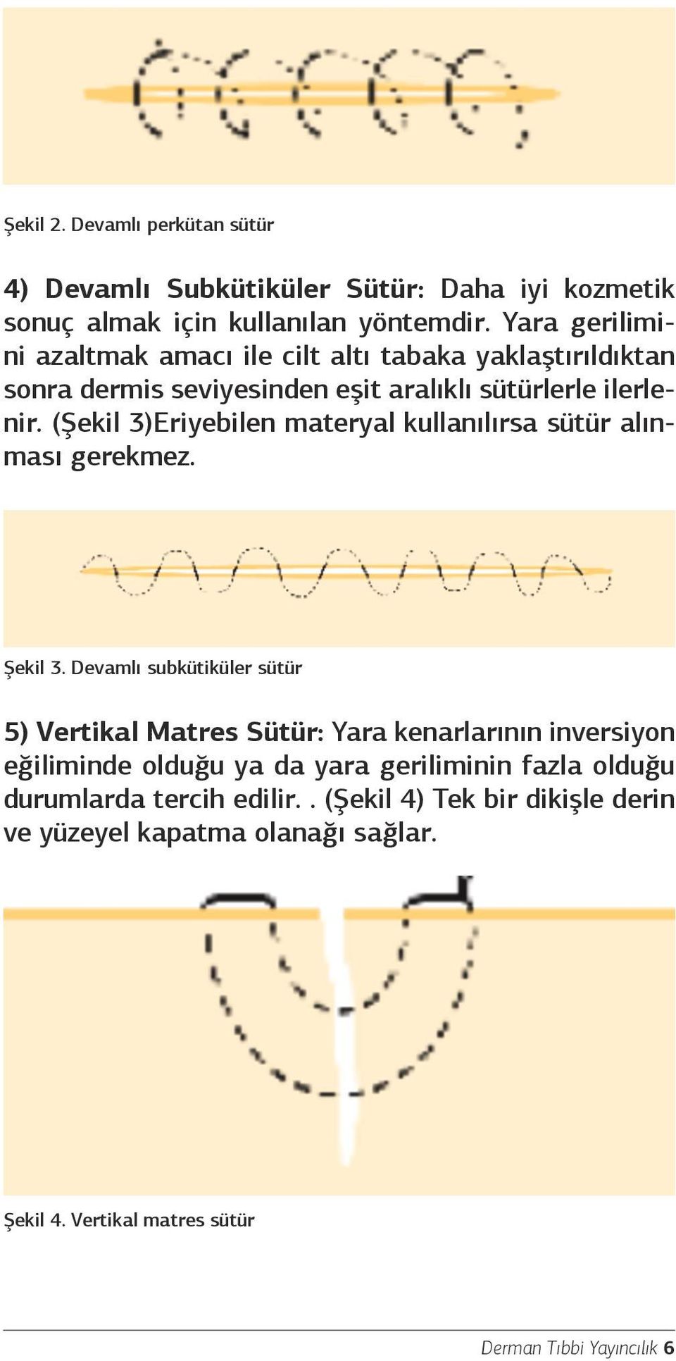 (Şekil 3)Eriyebilen materyal kullanılırsa sütür alınması gerekmez. Şekil 3.