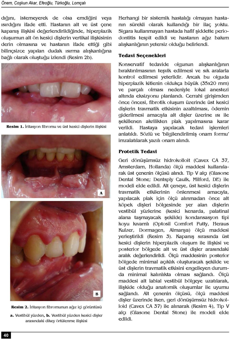 ısırma alışkanlığına bağlı olarak oluştuğu izlendi (Resim 2b). Resim 1. İritasyon fibromu ve üst kesici dişlerin ilişkisi B Resim 2. İritasyon fibromunun ağız içi görüntüsü a. Vestibül yüzden, b.