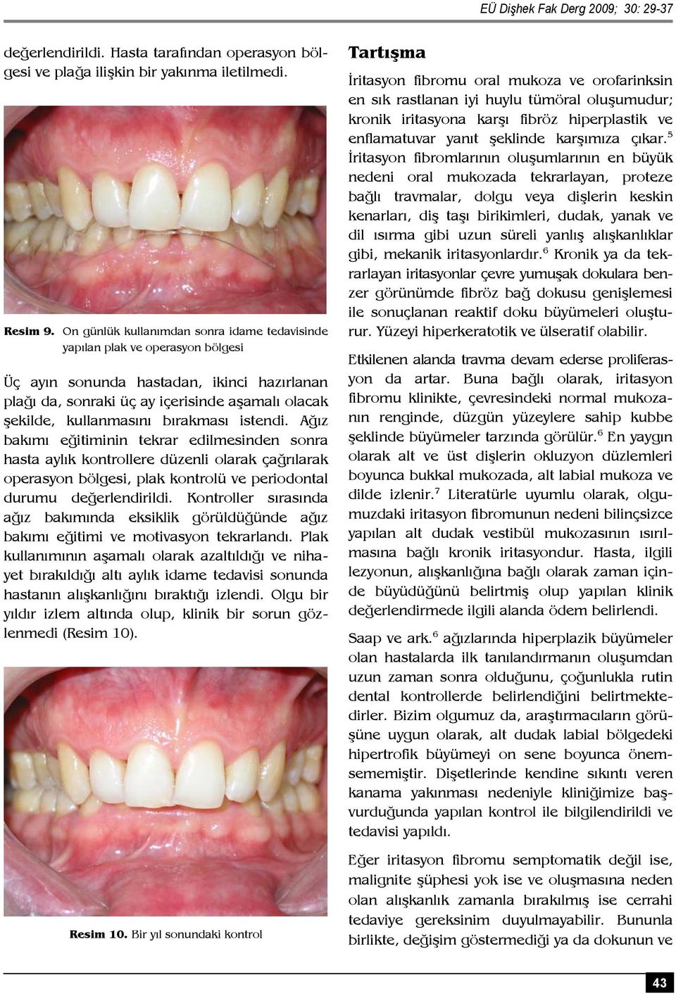 bırakması istendi. Ağız bakımı eğitiminin tekrar edilmesinden sonra hasta aylık kontrollere düzenli olarak çağrılarak operasyon bölgesi, plak kontrolü ve periodontal durumu değerlendirildi.