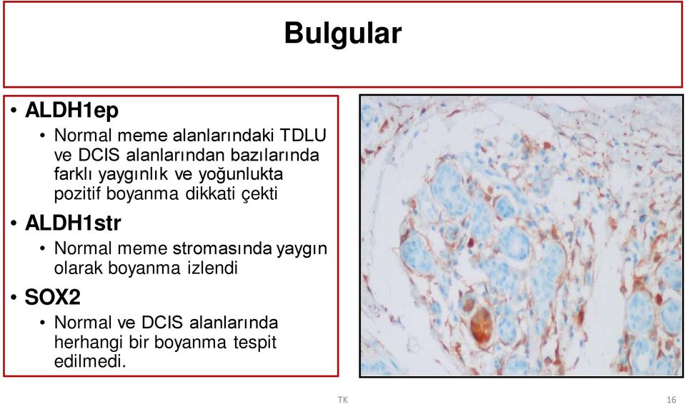 çekti ALDH1str Normal meme stromasında yaygın olarak boyanma izlendi