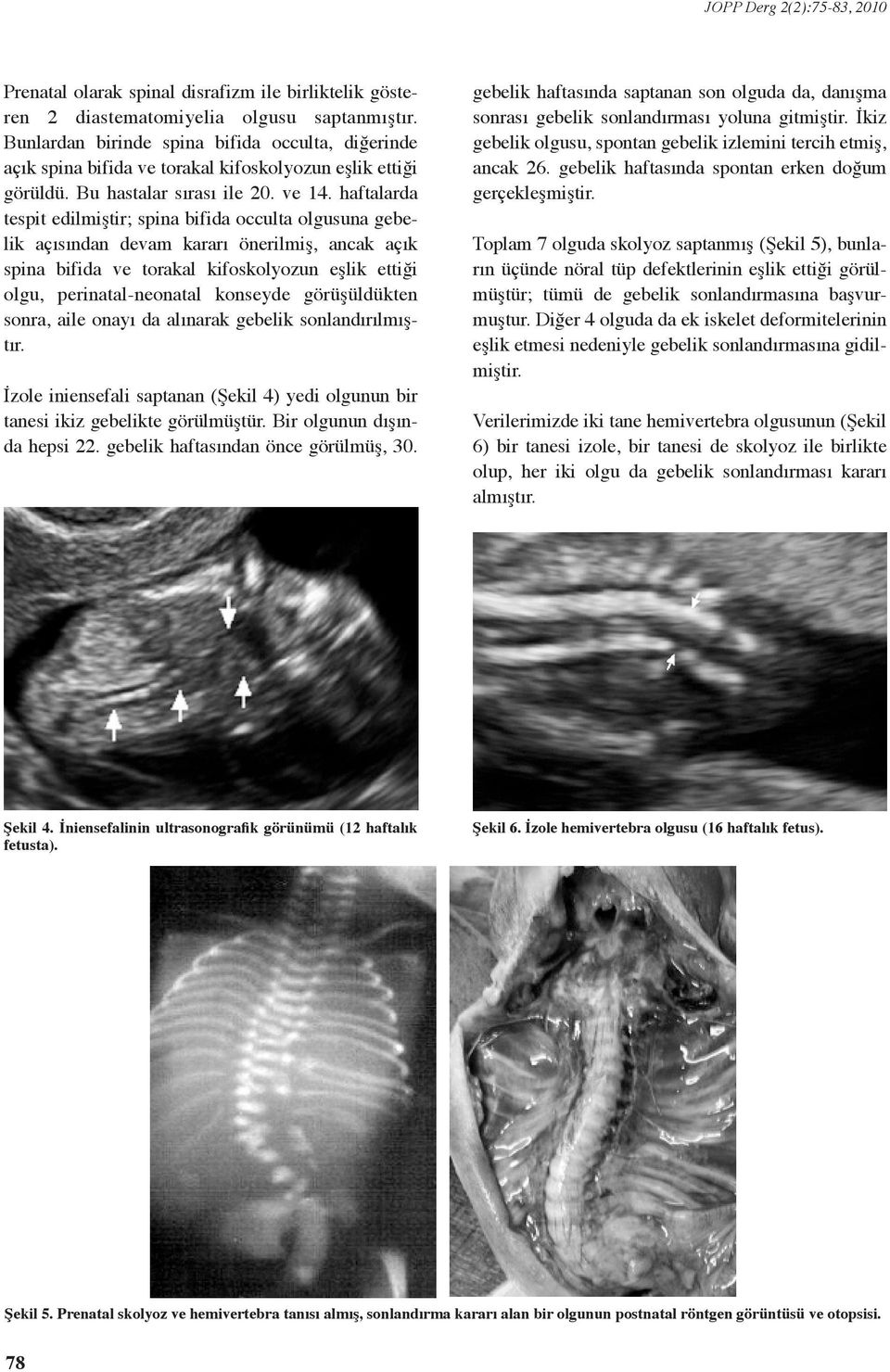 haftalarda tespit edilmiştir; spina bifida occulta olgusuna gebelik açısından devam kararı önerilmiş, ancak açık spina bifida ve torakal kifoskolyozun eşlik ettiği olgu, perinatal-neonatal konseyde