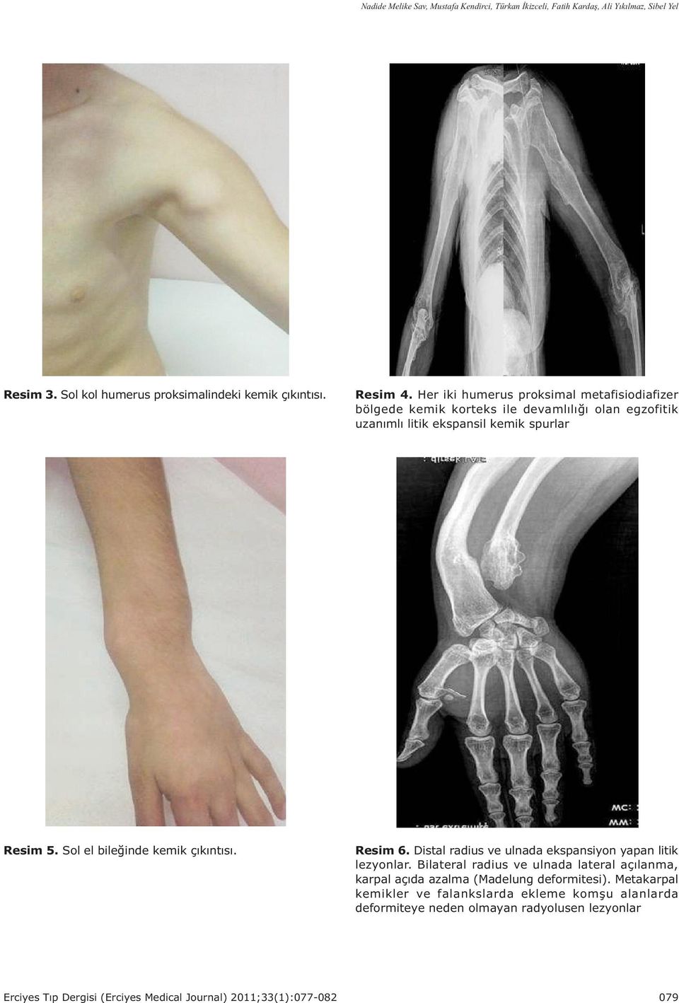 Sol el bileðinde kemik çýkýntýsý. Resim 6. Distal radius ve ulnada ekspansiyon yapan litik lezyonlar.