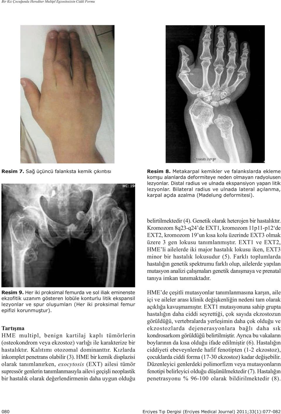 Bilateral radius ve ulnada lateral açýlanma, karpal açýda azalma (Madelung deformitesi). belirtilmektedir (4). Genetik olarak heterojen bir hastalýktýr.