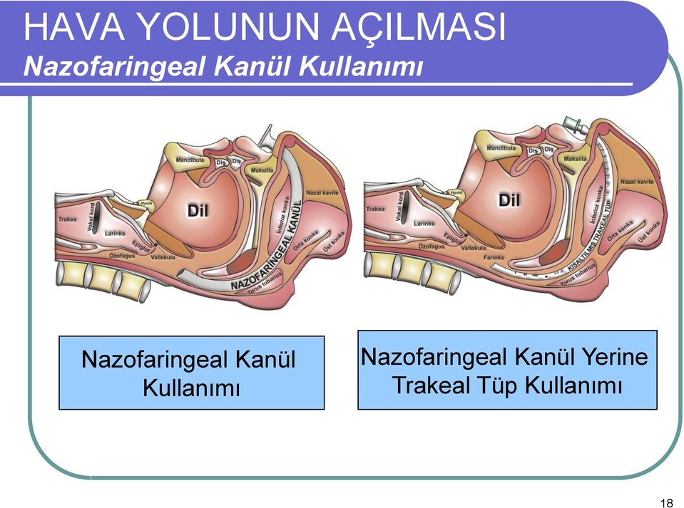 Nazofaringeal Kanül Yerine