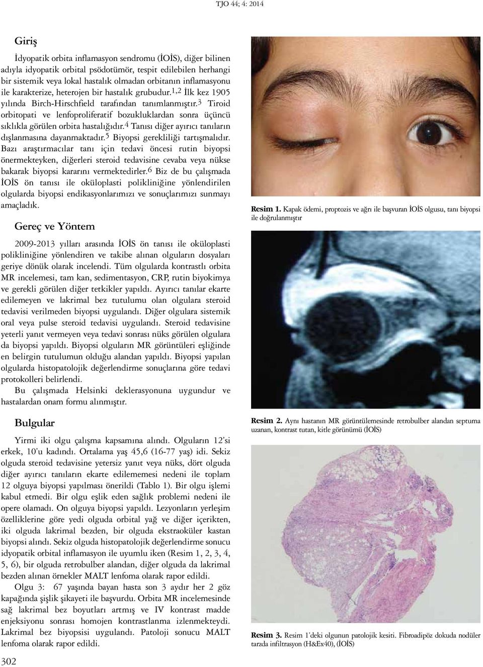 3 Tiroid orbitopati ve lenfoproliferatif bozukluklardan sonra üçüncü sıklıkla görülen orbita hastalığıdır.4 Tanısı diğer ayırıcı tanıların dışlanmasına dayanmaktadır.