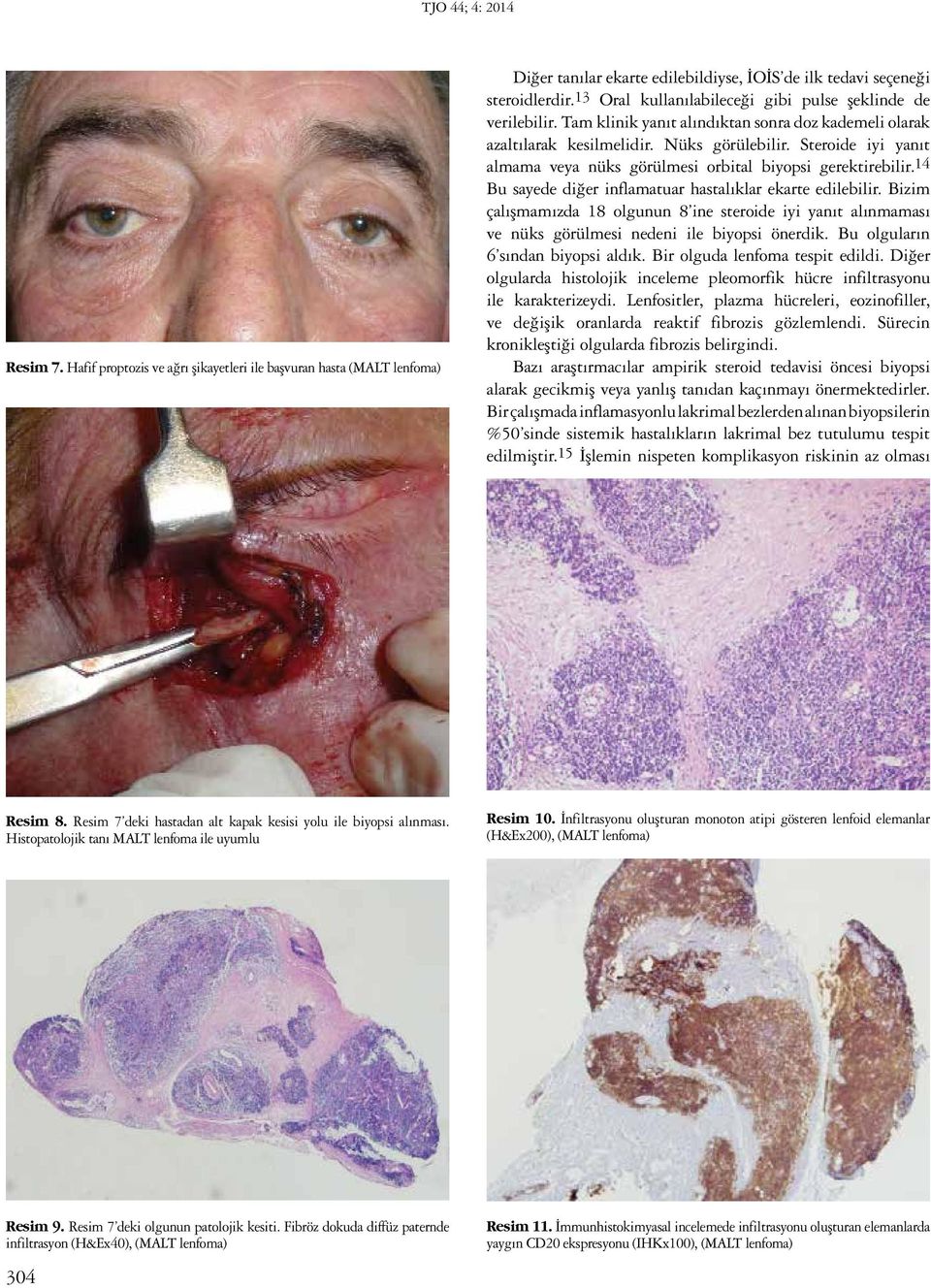 Steroide iyi yanıt almama veya nüks görülmesi orbital biyopsi gerektirebilir.14 Bu sayede diğer inflamatuar hastalıklar ekarte edilebilir.