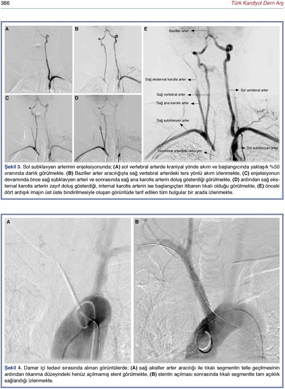 (B) Baziller arter aracılığıyla sağ vertebral arterdeki ters yönlü akım izlenmekte, (C) enjeksiyonun devamında önce sağ subklavyen arteri ve sonrasında sağ ana karotis arterin doluş gösterdiği