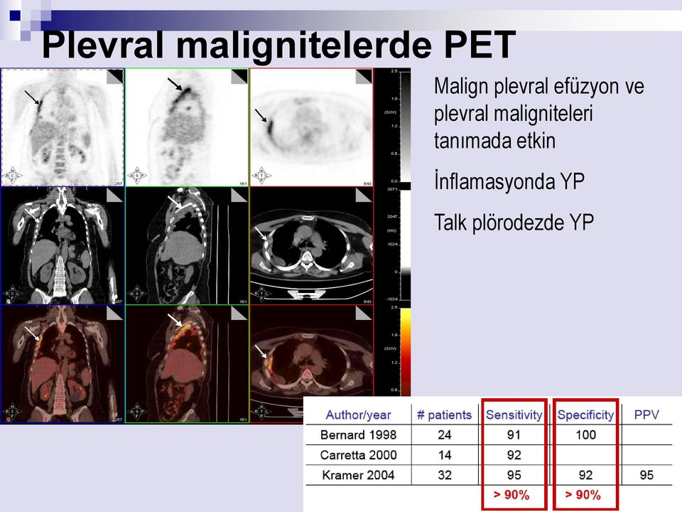 plevral maligniteleri tanımada