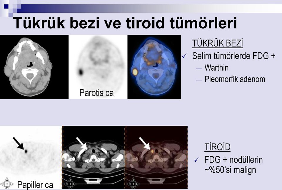 tümörlerde FDG + Warthin Pleomorfik