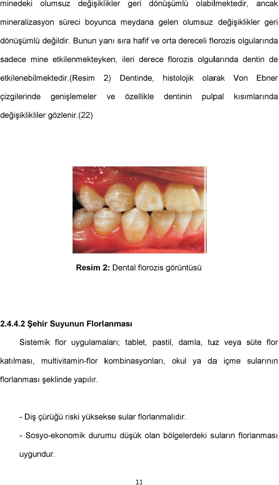 (Resim 2) Dentinde, histolojik olarak Von Ebner çizgilerinde genişlemeler ve özellikle dentinin pulpal kısımlarında değişiklikliler gözlenir.(22) Resim 2: Dental florozis görüntüsü 2.4.