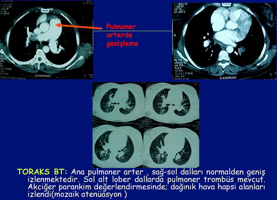 Sol alt lober dallarda pulmoner trombüs mevcut.