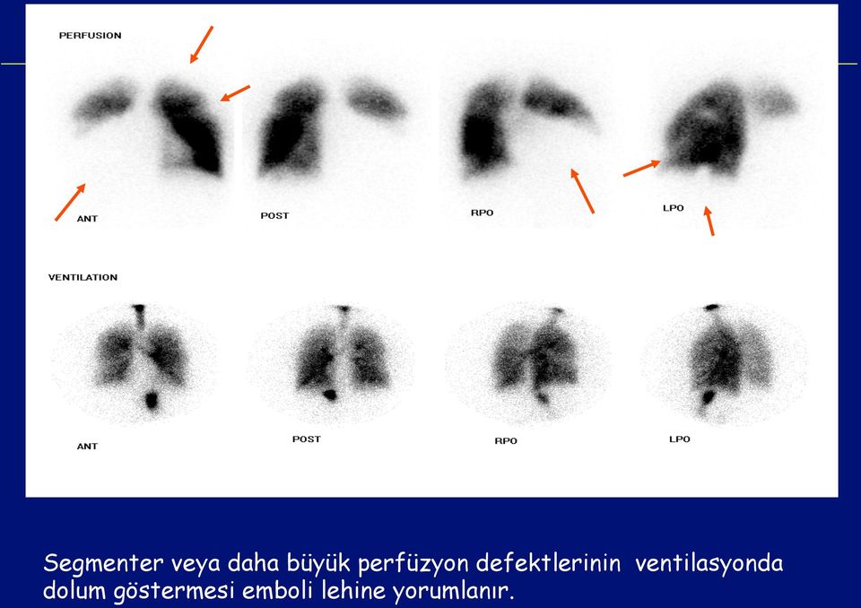 ventilasyonda dolum