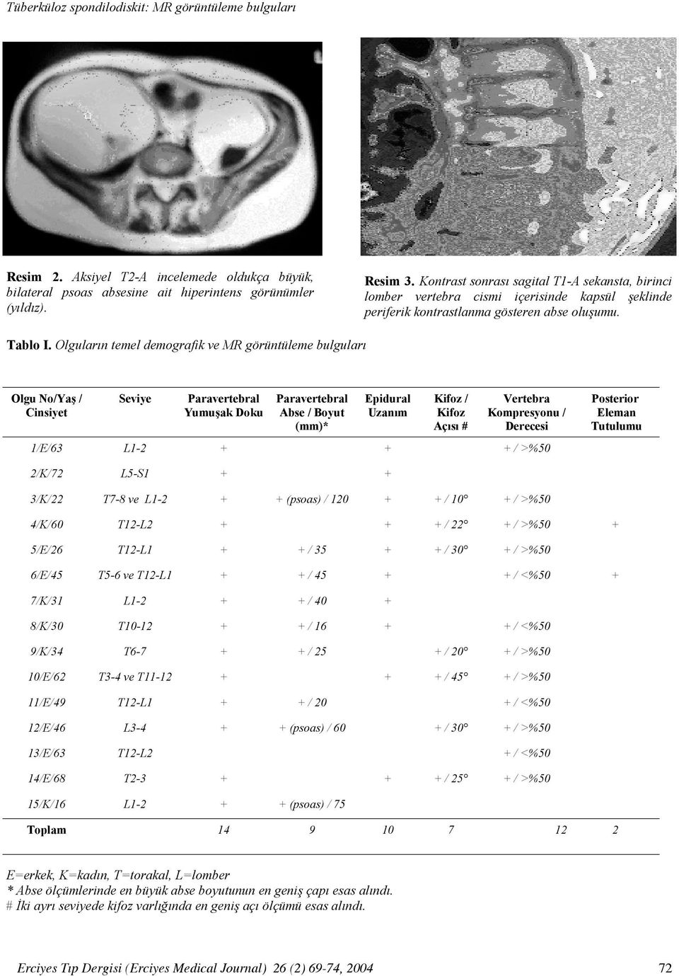 Olguların temel demografik ve MR görüntüleme bulguları Olgu No/Yaş / Cinsiyet Seviye Paravertebral Yumuşak Doku Paravertebral Abse / Boyut (mm)* Epidural Uzanım Kifoz / Kifoz Açısı # Vertebra