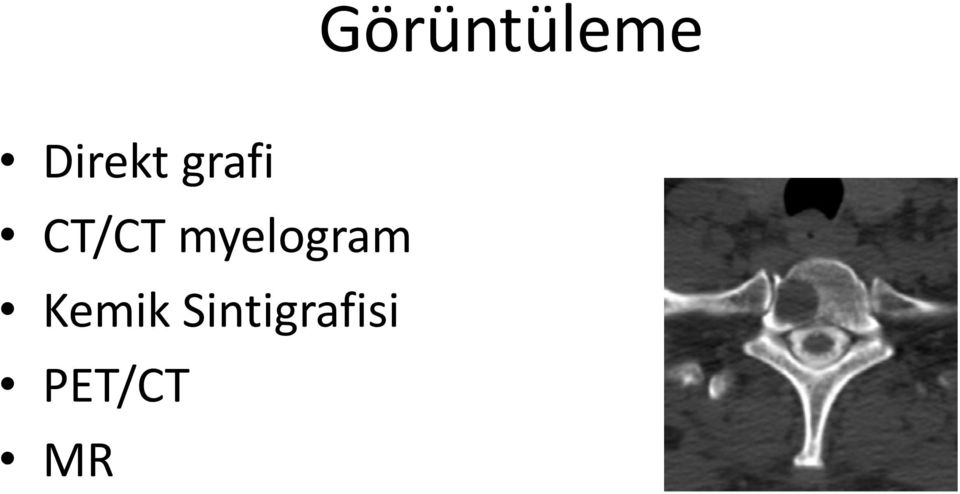 CT/CT myelogram