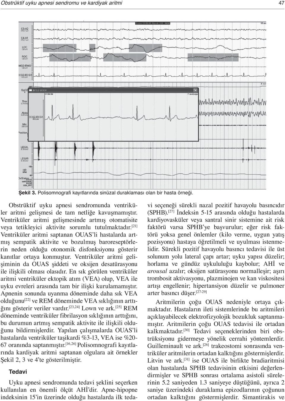 [21] Ventriküler aritmi saptanan OUAS li hastalarda artmı sempatik aktivite ve bozulmu baroreseptörlerin neden oldu u otonomik disfonksiyonu gösterir kanıtlar ortaya konmu tur.
