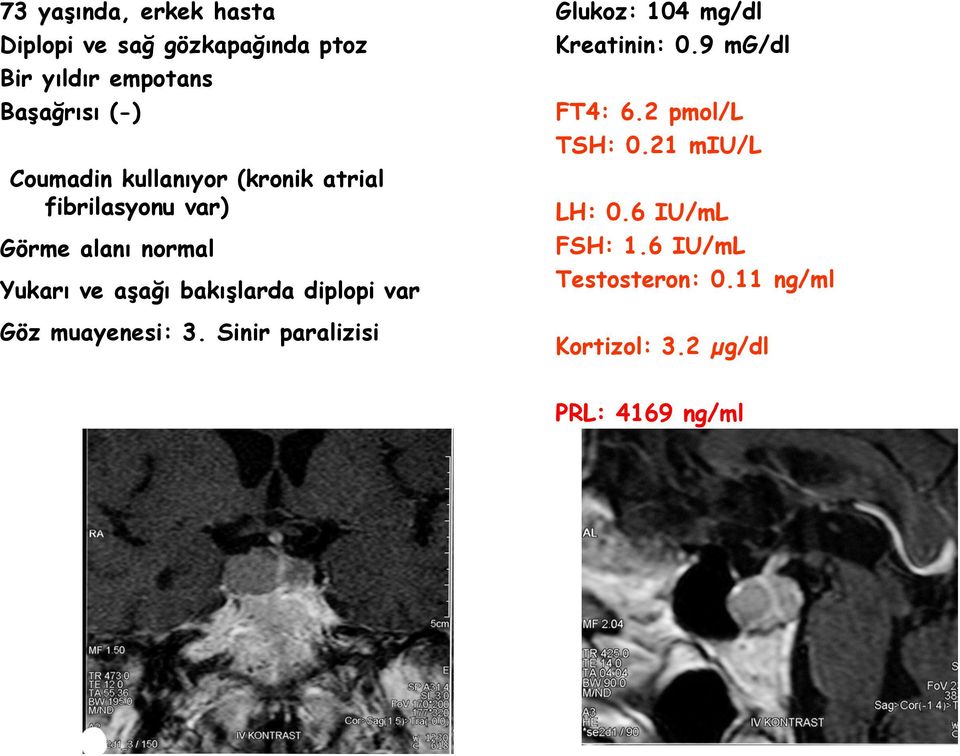 diplopi var Göz muayenesi: 3. Sinir paralizisi Glukoz: 104 mg/dl Kreatinin: 0.9 mg/dl FT4: 6.