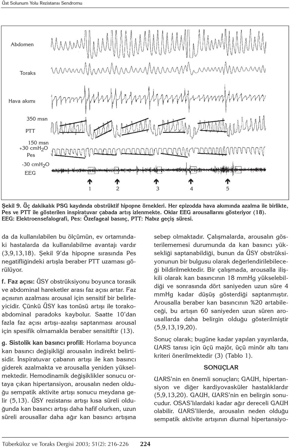 EEG: Elektroensefalografi, Pes: Özefageal basınç, PTT: Nabız geçiş süresi. da da kullanılabilen bu ölçümün, ev ortamındaki hastalarda da kullanılabilme avantajı vardır (3,9,13,18).