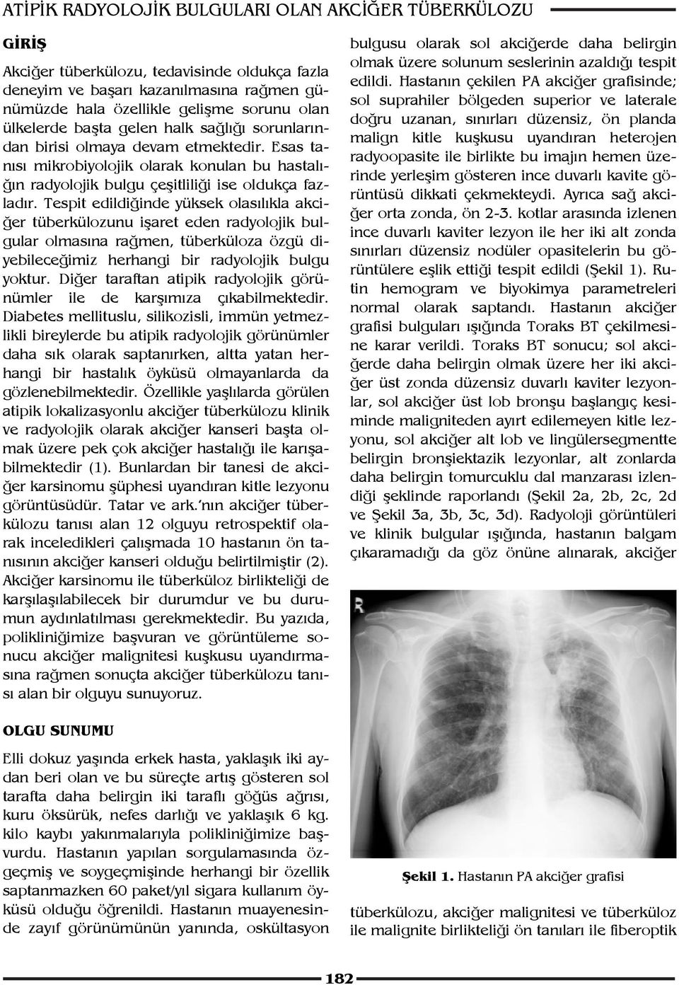 Tespit edildiğinde yüksek olasılıkla akciğer tüberkülozunu işaret eden radyolojik bulgular olmasına rağmen, tüberküloza özgü diyebileceğimiz herhangi bir radyolojik bulgu yoktur.