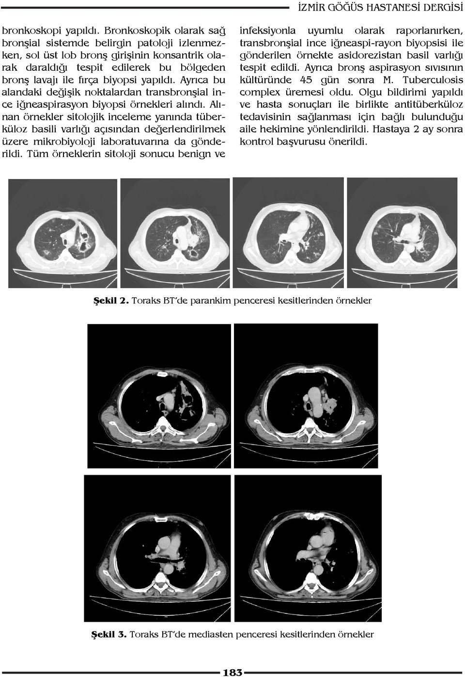 Ayrıca bu alandaki değişik noktalardan transbronşial ince iğneaspirasyon biyopsi örnekleri alındı.