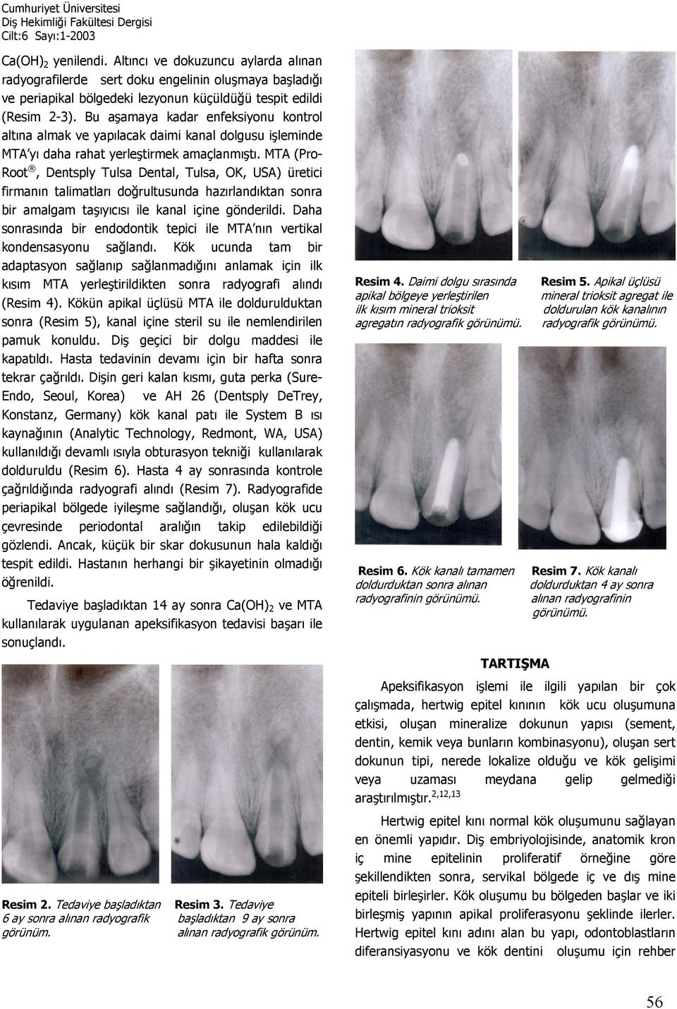 MTA (Pro- Root, Dentsply Tulsa Dental, Tulsa, OK, USA) üretici firmanın talimatları doğrultusunda hazırlandıktan sonra bir amalgam taşıyıcısı ile kanal içine gönderildi.