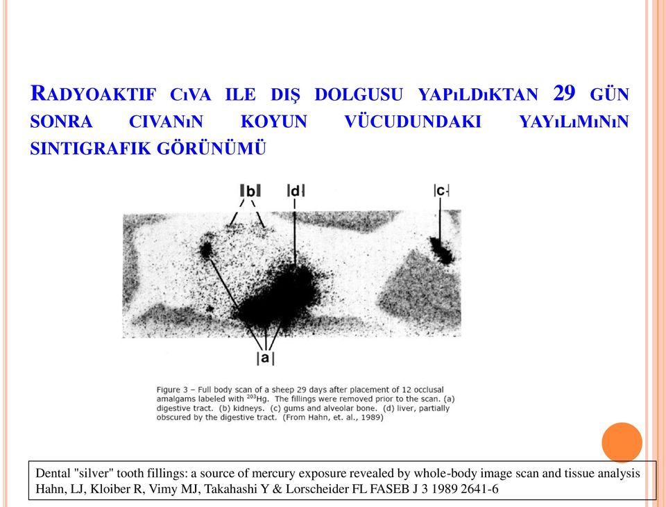 a source of mercury exposure revealed by whole-body image scan and tissue