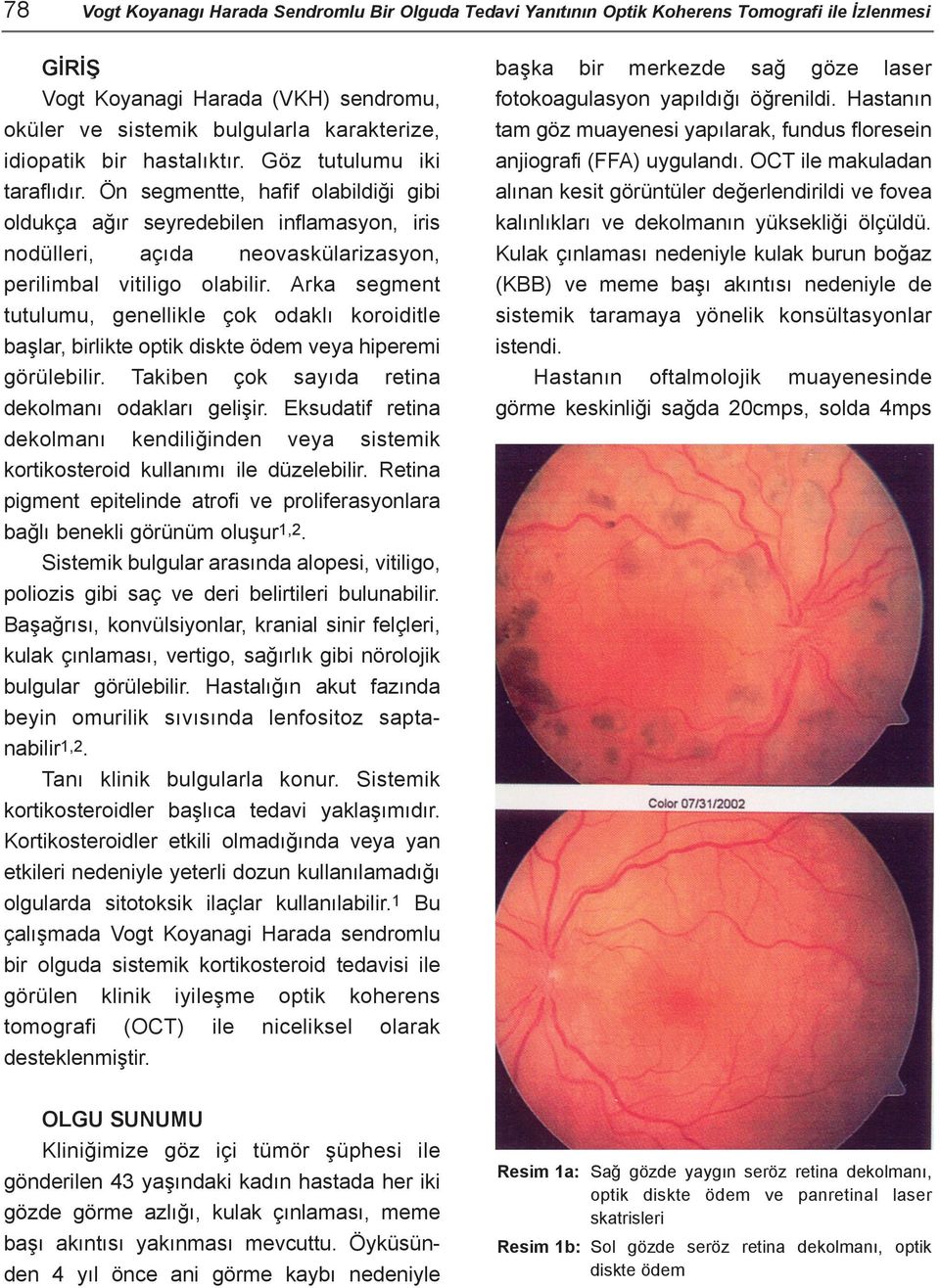 Arka segment tutulumu, genellikle çok odaklý koroiditle baþlar, birlikte optik diskte ödem veya hiperemi görülebilir. Takiben çok sayýda retina dekolmaný odaklarý geliþir.