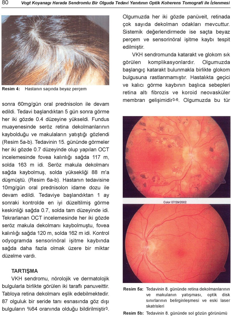 gününde görmeler her iki gözde 0.7 düzeyinde olup yapýlan OCT incelemesinde fovea kalýnlýðý saðda 117 m, solda 163 m idi. Seröz makula dekolmaný saðda kaybolmuþ, solda yüksekliði 88 m'a düþmüþtü.