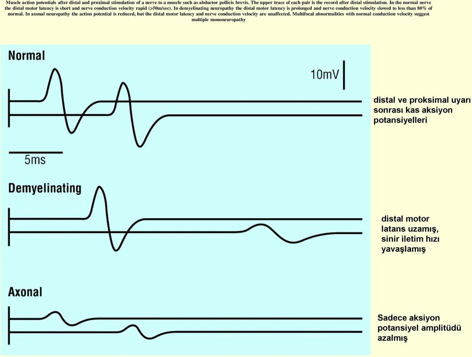 In demyelinating neuropathy the distal motor latency is prolonged and nerve conduction velocity slowed to less than 80% of normal.