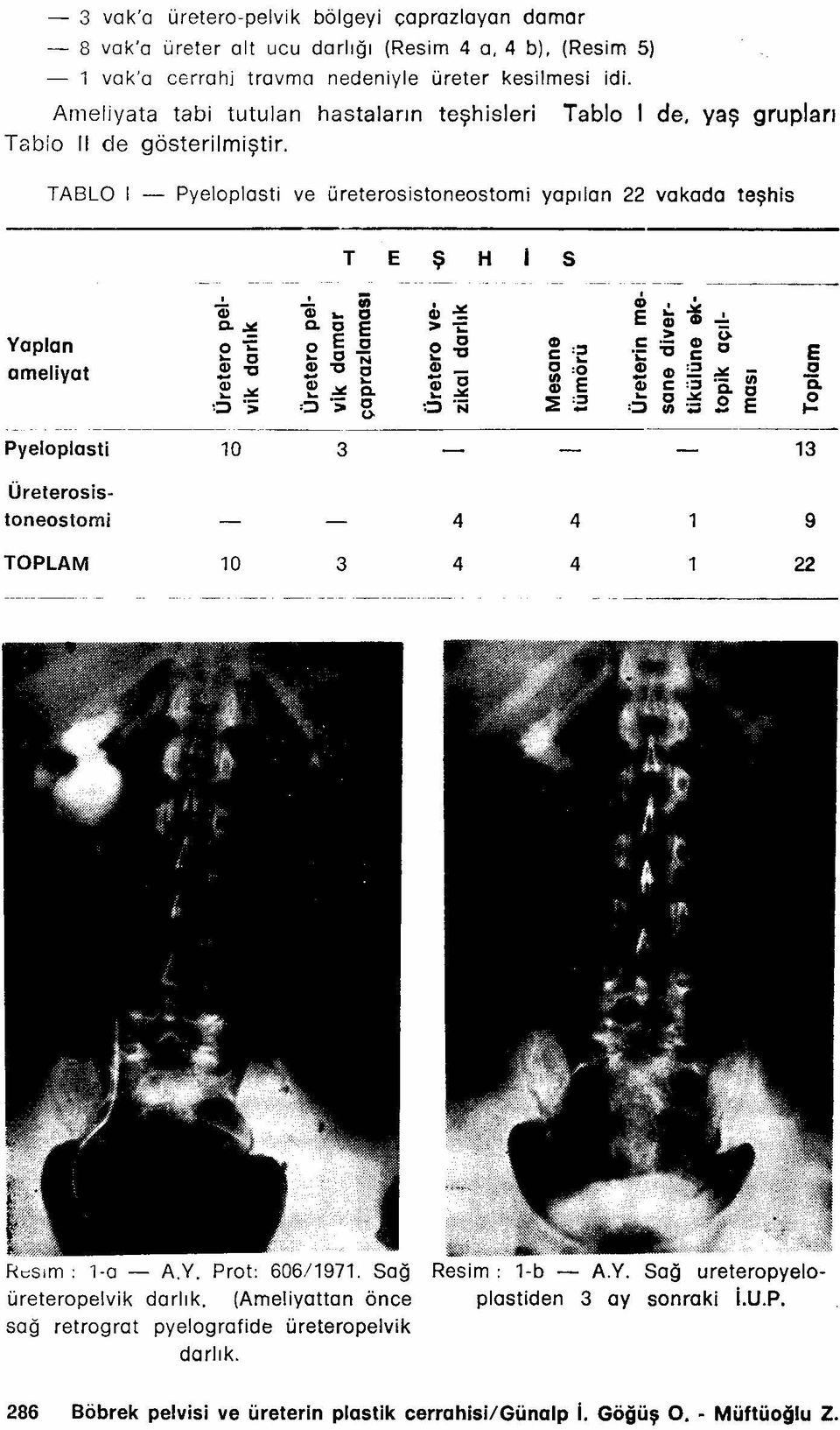 TABLO i - Pyeloplasti ve üreterosistoneostomi yapılan 22 yakada teşhis T E Ş H S ------- -~-------, ~ iii ıl> cb ı!..ı:ı: ai...>o: CIL c, c.~ c. c E CIL Gl E > i: > Ü.... c... c N... 'c C.