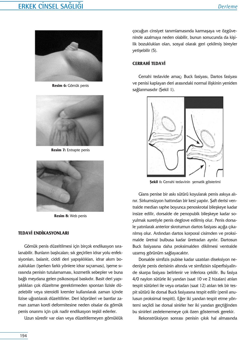 Resim 7: Entrapte penis fiekil 1: Cerrahi tedavinin flematik gösterimi TEDAV END KASYONLARI Resim 8: Web penis Gömük penis düzeltilmesi için birçok endikasyon s ralanabilir.