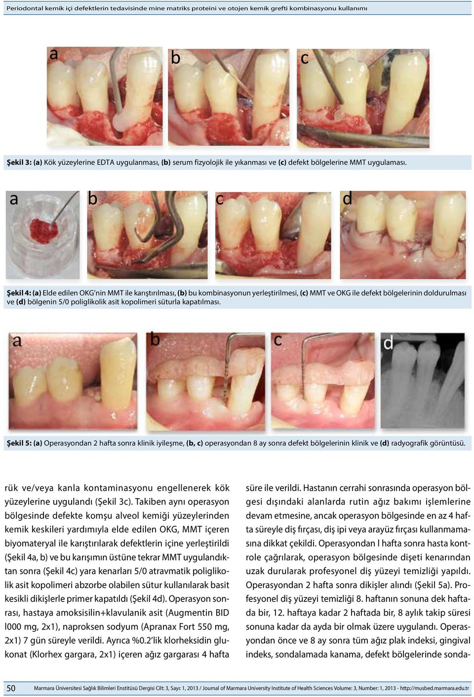 a b c d Şekil 4: (a) Elde edilen OKG nin MMT ile karıştırılması, (b) bu kombinasyonun yerleştirilmesi, (c) MMT ve OKG ile defekt bölgelerinin doldurulması ve (d) bölgenin 5/0 poliglikolik asit