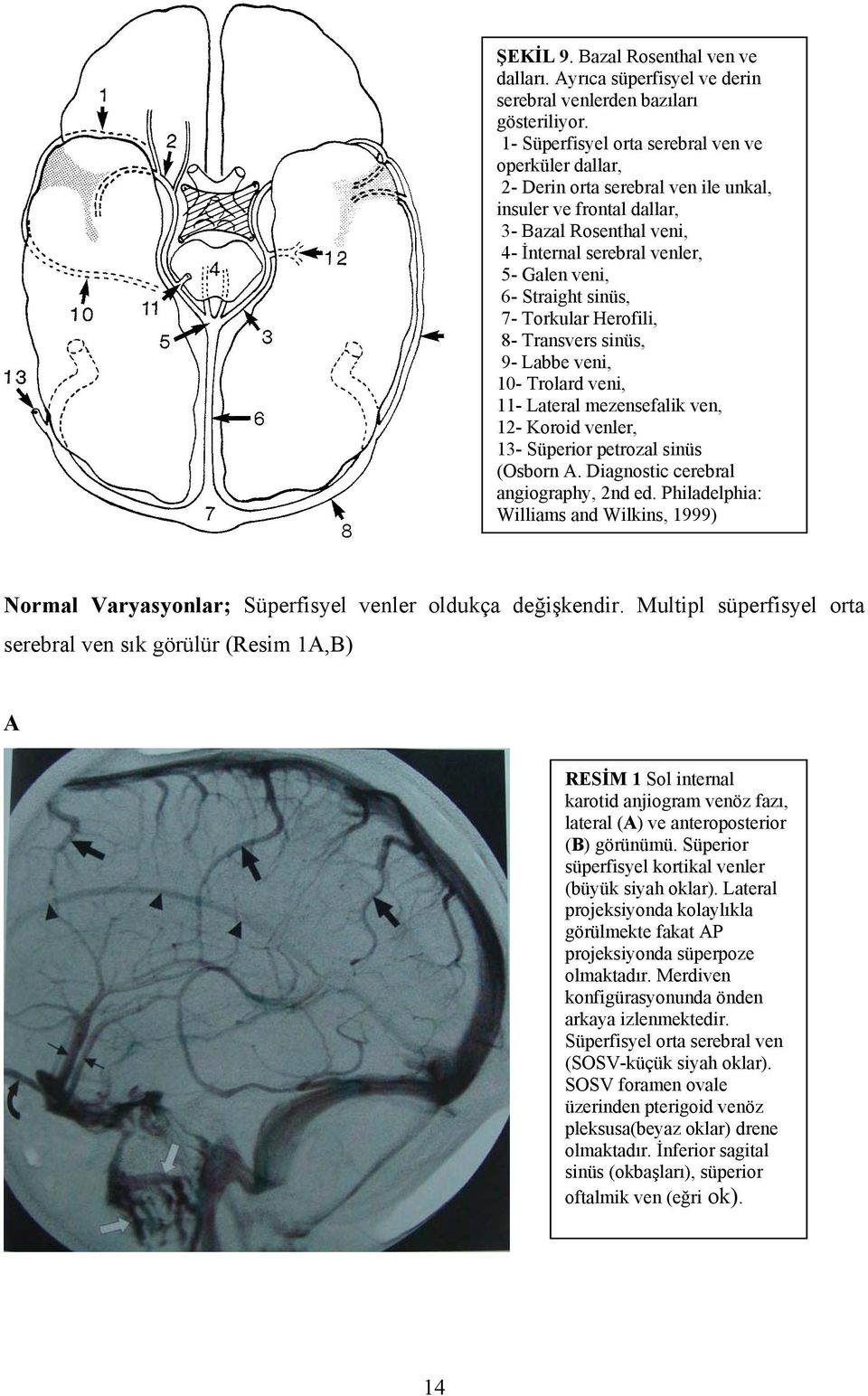 sinüs, 7- Torkular Herofili, 8- Transvers sinüs, 9- Labbe veni, 10- Trolard veni, 11- Lateral mezensefalik ven, 12- Koroid venler, 13- Süperior petrozal sinüs (Osborn A.