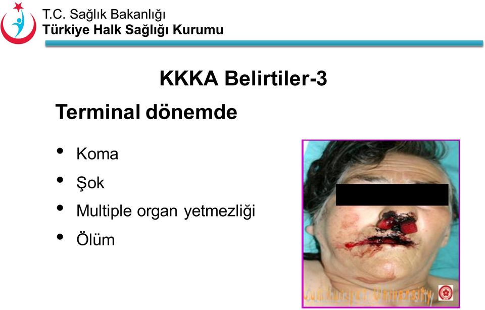 Koma Şok Multiple