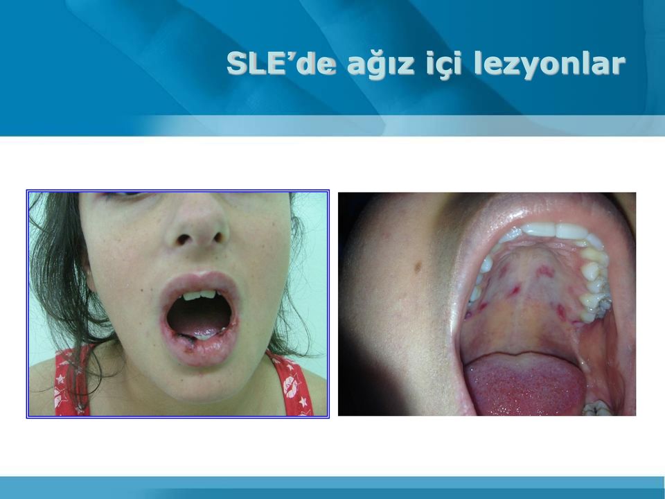 lezyonlar