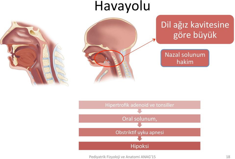 Hipertrofik adenoid ve tonsiller