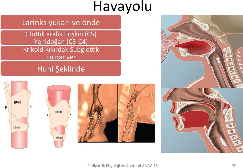 (C3- C4) Krikoid Kıkırdak