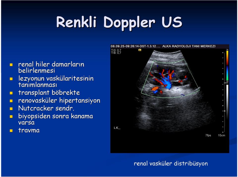böbrektebrekte renovasküler hipertansiyon Nutcracker sendr.