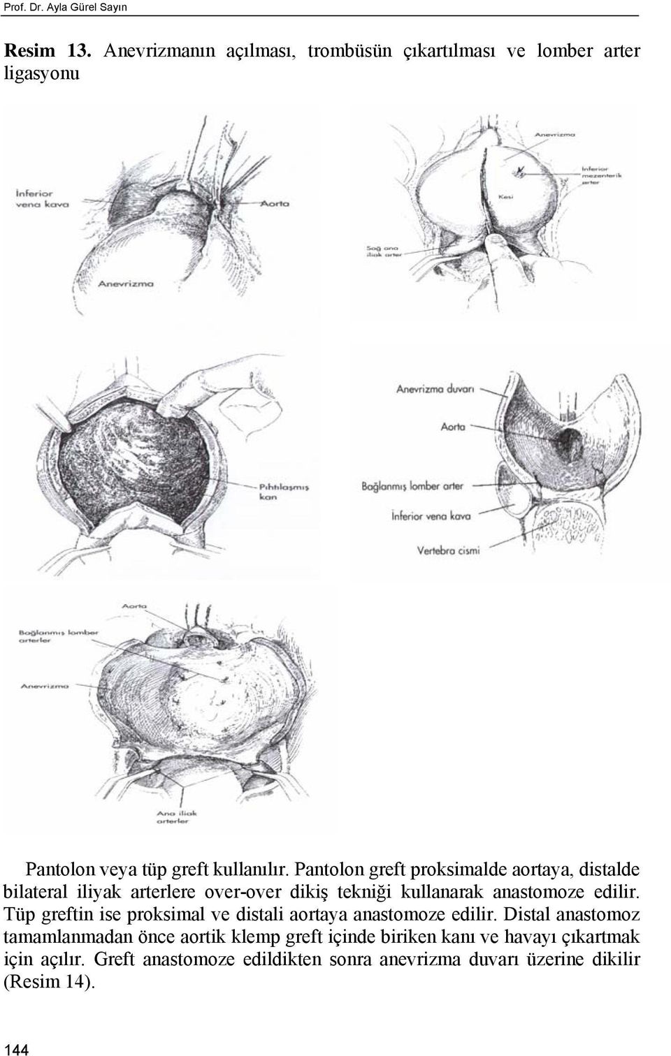 Pantolon greft proksimalde aortaya, distalde bilateral iliyak arterlere over-over dikiş tekniği kullanarak anastomoze edilir.